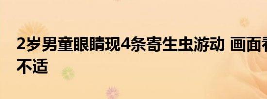 2岁男童眼睛现4条寄生虫游动 画面看了让人不适