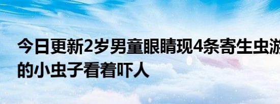 今日更新2岁男童眼睛现4条寄生虫游动 蠕动的小虫子看着吓人