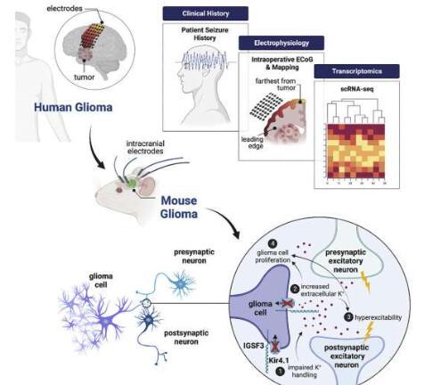对神经胶质瘤相关癫痫驱动因素的新见解