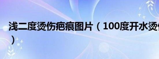 浅二度烫伤疤痕图片（100度开水烫伤严重吗）