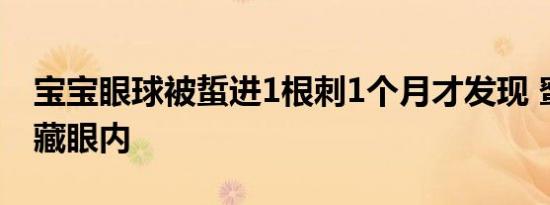 宝宝眼球被蜇进1根刺1个月才发现 蜜蜂尾针藏眼内